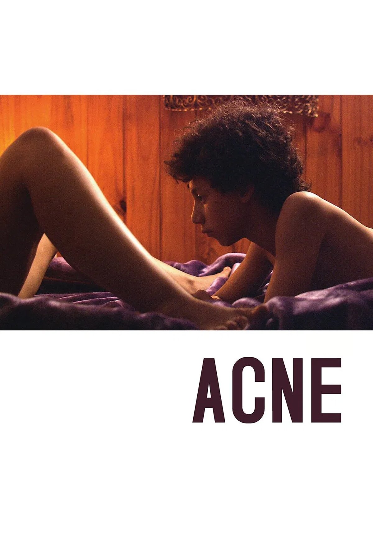 Acné