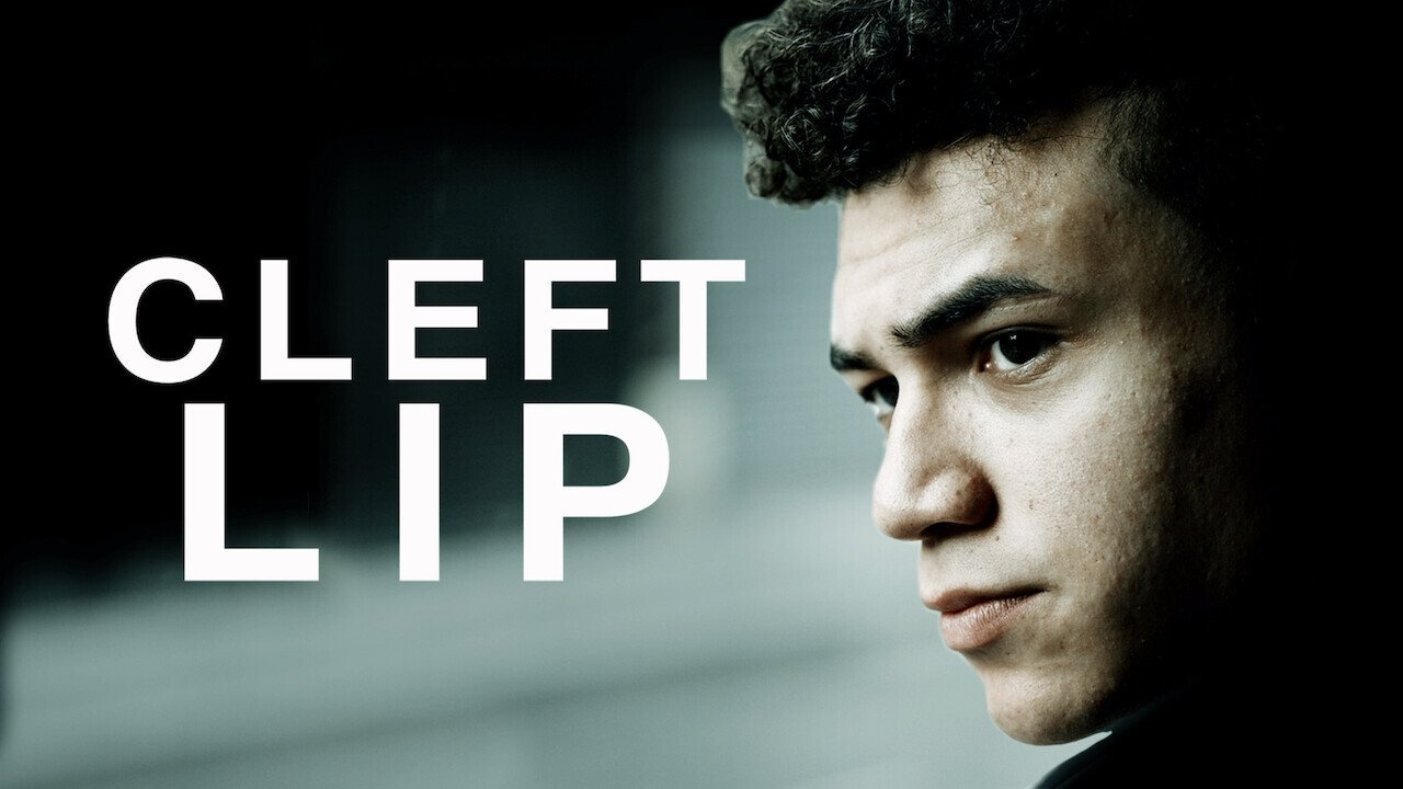 Cleft Lip|Cleft Lip